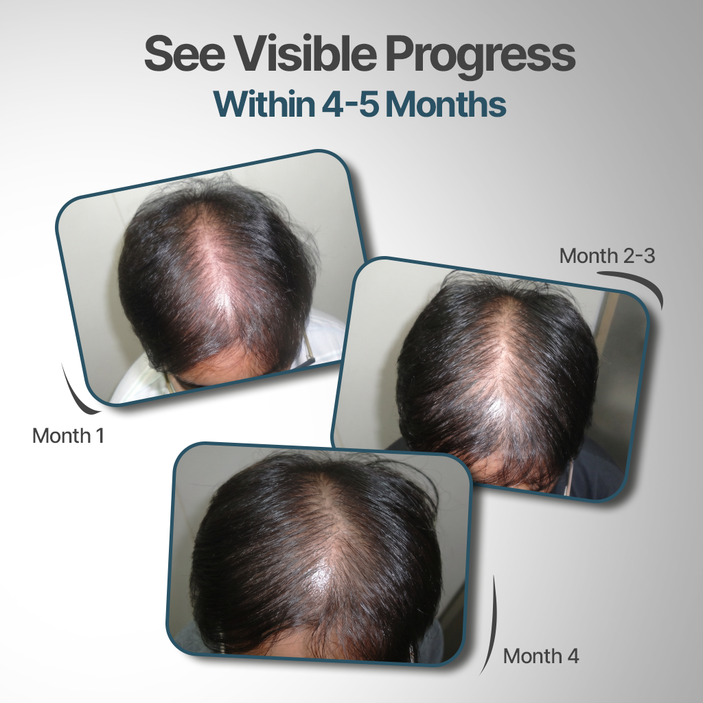 Cyclical Nutrition Supplement Kit for Hair Fall